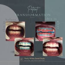 Veneers